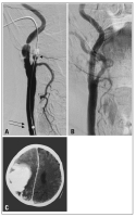 Abbildung 2a-c: Angiographie - MRT