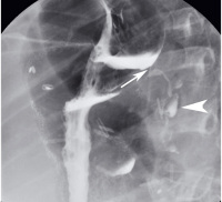 Abbildung 1: Gastro-bronchiale Fistel