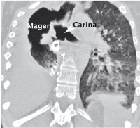 Abbildung 2a: Gastro-bronchiale Fistel