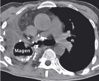 Abbildung 2b: Gastro-bronchiale Fistel