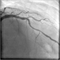 Abbildung 1: LAD Stenosis