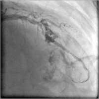 Abbildung 4: Coronary perforation