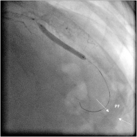 Abbildung 5: Pericardial fluid