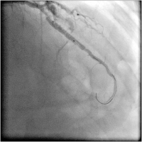 Abbildung 6: Stent