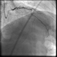 Abbildung 8: Direct Stenting