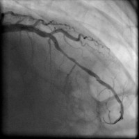 Abbildung 12: Direct Stenting