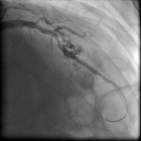 Abbildung 13: Direct Stenting