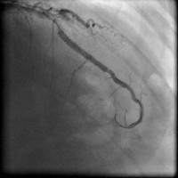Abbildung 9: Direct Stenting