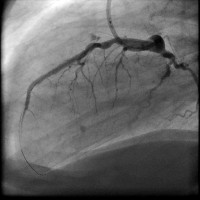 Abbildung 18: Direct Stenting