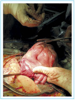Abbildung 2: Damage Control Surgery