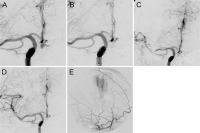 Abbildung 10a-e: Angiogramme