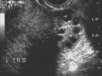 Abbildung 2: PCOS