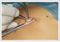Abbildung 1: Single-Incision Laparoscopic Surgery