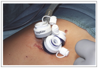 Abbildung 2: Single-Incision Laparoscopic Surgery