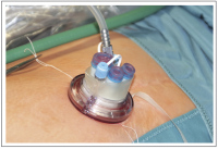 Abbildung 3: Single-Incision Laparoscopic Surgery