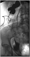 Abbildung 4: Single-Incision Laparoscopic Surgery