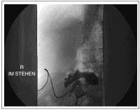 Abbildung 5: Single-Incision Laparoscopic Surgery