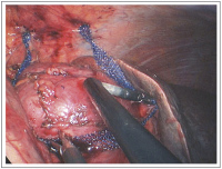 Abbildung 6: Single-Incision Laparoscopic Surgery