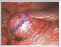 Abbildung 7: Single-Incision Laparoscopic Surgery