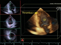 Abbildung 5: Thrombus