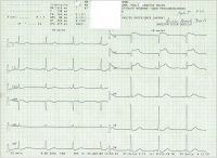 Abbildung 1: EKG