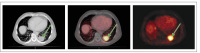 Abbildung 3: Pulmonale Metastase