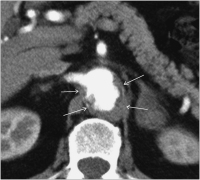 Abbildung 1: Aorta