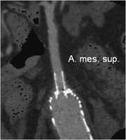 Abbildung 6: CT - MIP-Rekonstruktion