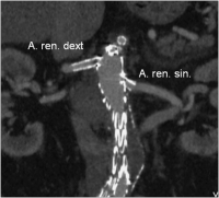 Abbildung 7: CT - MIP-Rekonstruktion