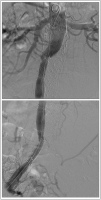 Abbildung 2: Aortenstentgraft