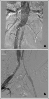 Abbildung 3a-b: Aortenstentgraft