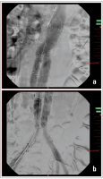 Abbildung 4a-b: Aortenstentgraft