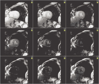 Abbildung 6: Cardiac MR