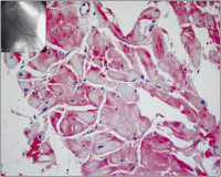 Abbildung 7: Histologie der Myokardbiopsie