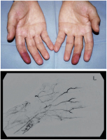 Abbildung 1: Raynaud-Phnomen