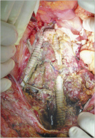 Abbildung 9: Aortenaneurysma