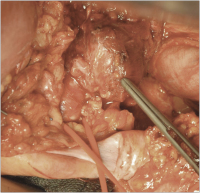 Abbildung 12: Aneurysma