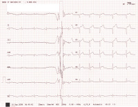 Abbildung 1: EKG