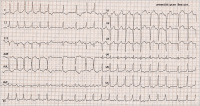 Abbildung 1: EKG