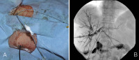 Abbildung 5a-b: Klatskin-Tumor