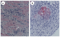 Abbildung 3a-b: Riesenzellmyokarditis