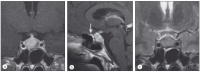 Abbildung 1a-c: Lymphozytre Adenohypophysitis
