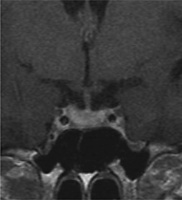 Abbildung 3: Lymphozytre Adenohypophysitis