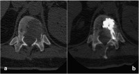 Abbildung 4a-b: Neoplastic osteolysis