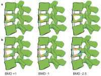 Abbildung 5a-b: Bone densities