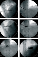 Abbildung 3a-f: Course of surgery