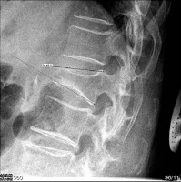 Abbildung 2: Lumbar vertebra