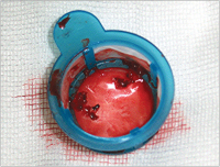 Abbildung 4: aspiriertes Thrombusmaterial