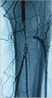 Abbildung 5: Thrombusaspirationsembolektomie