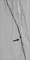 Abbildung 2: Ballonangioplastie